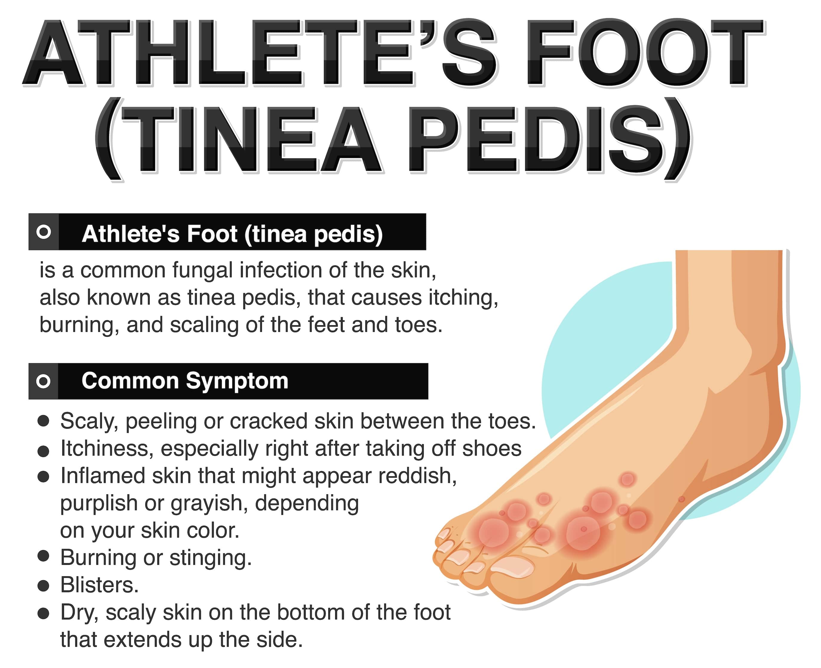 Athlete’s foot (tinea pedis) and Diabetes Athlete’s foot (tinea pedis) and Diabetes