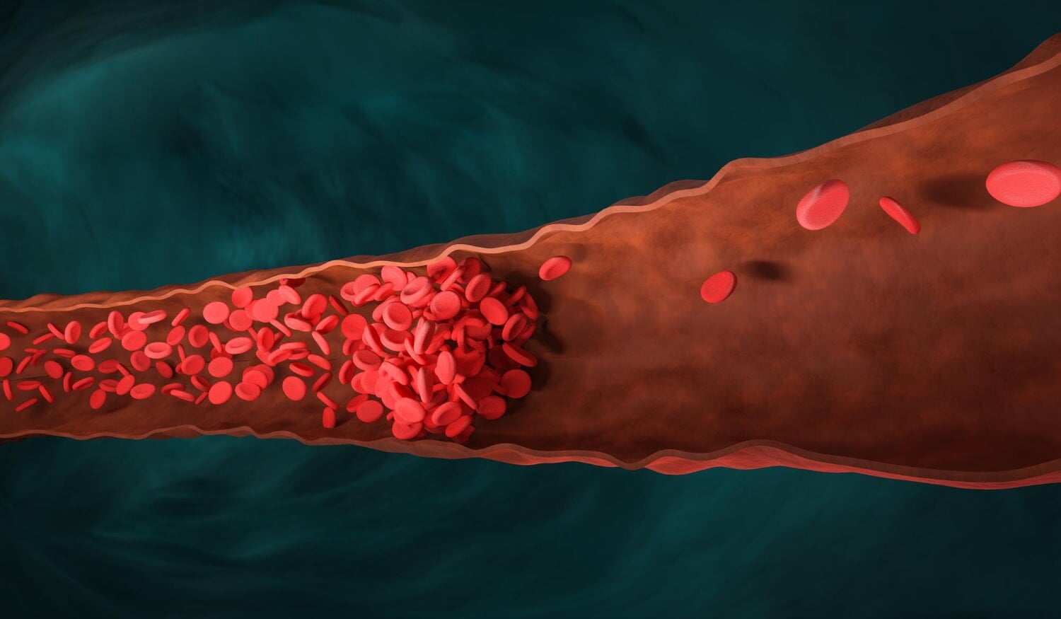 Using Compression Socks for Deep Vein Thrombosis Using Compression Socks for Deep Vein Thrombosis