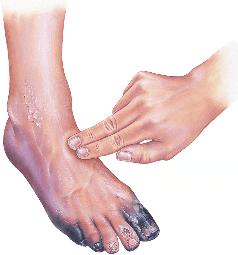 Gangrene foot