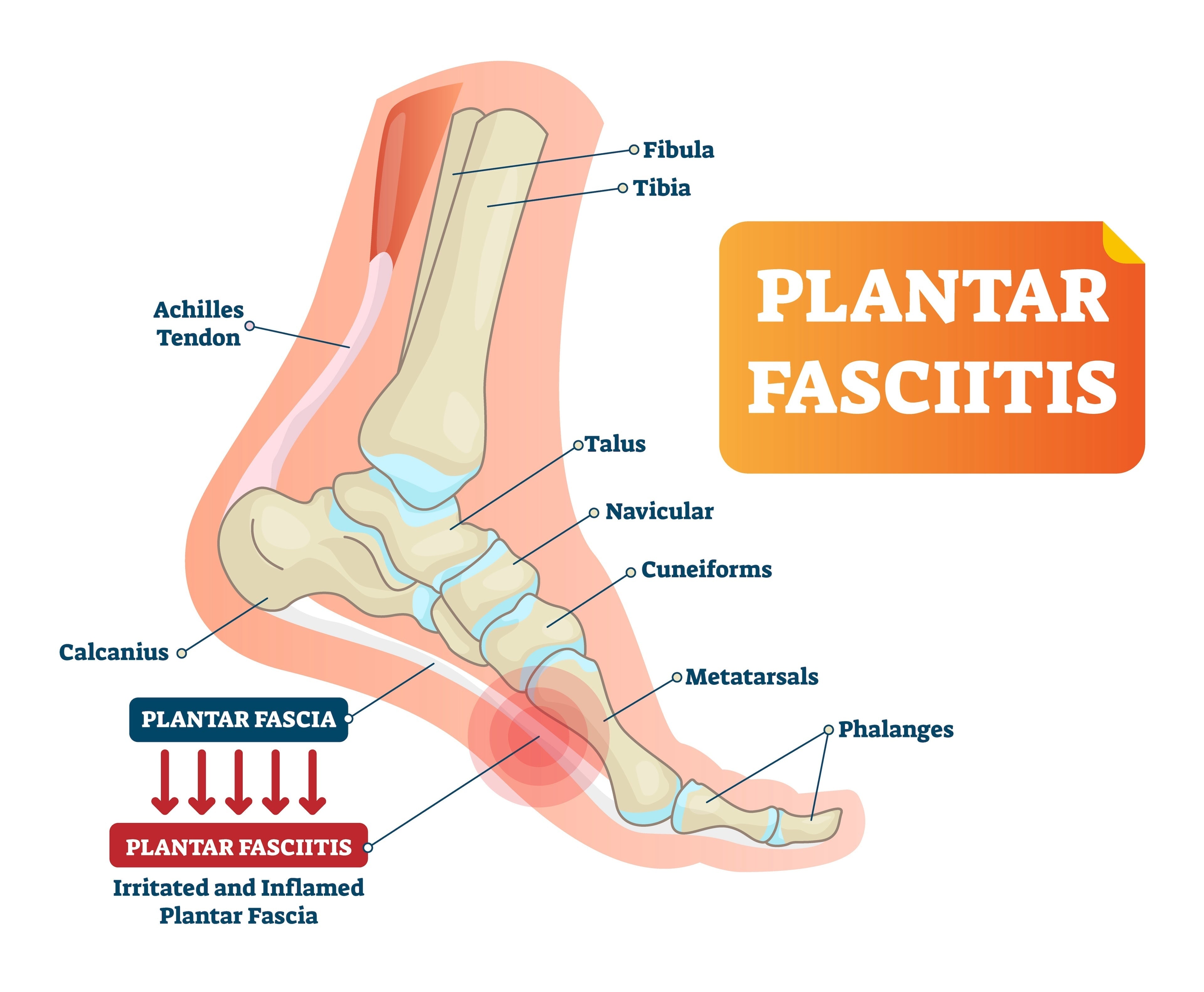 Plantar Fasciitis Plantar Fasciitis
