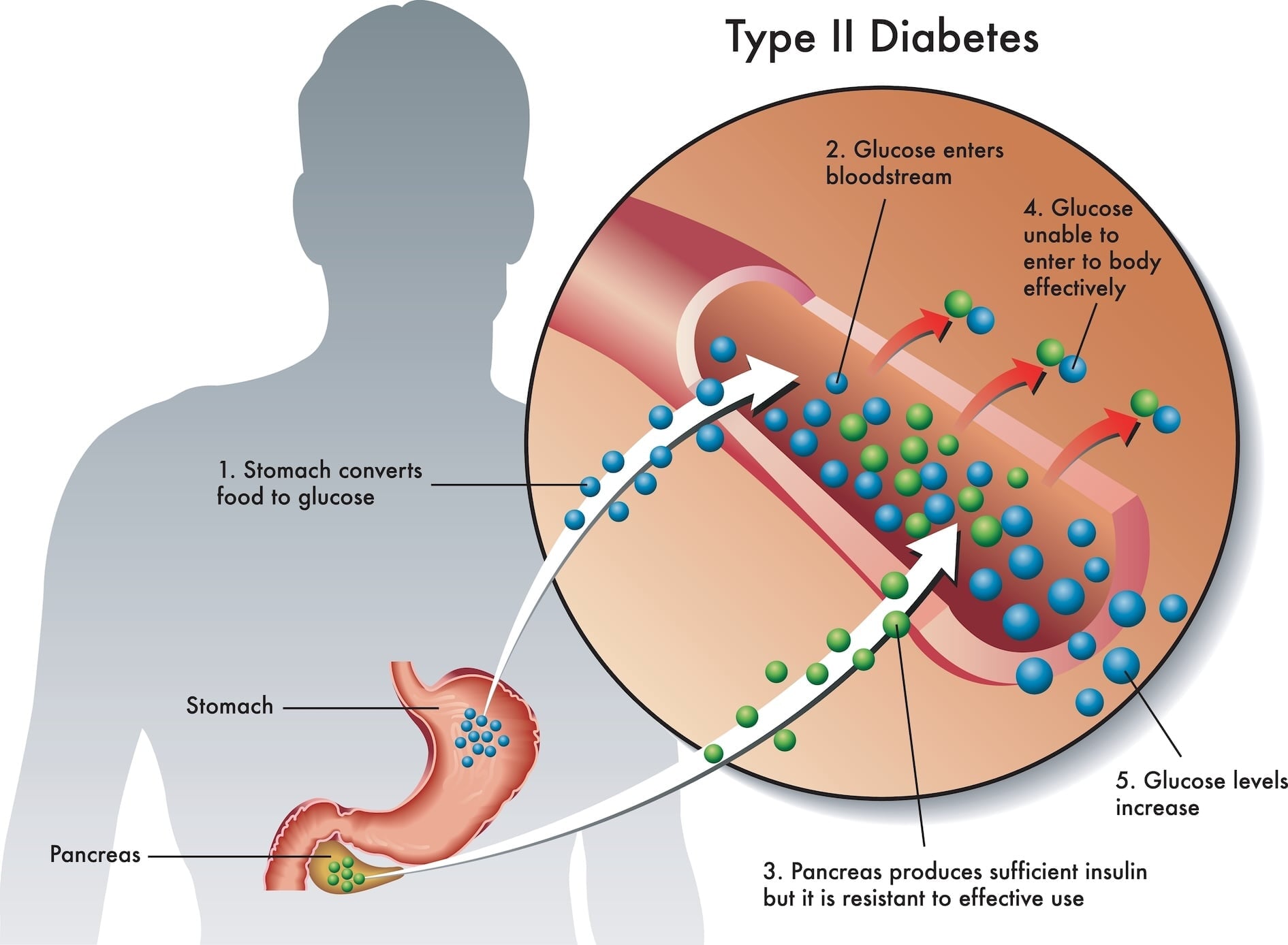 Risk Factors For Type 20 Diabetes & Prevention   Viasox