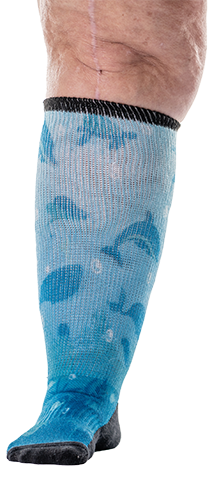 Obese leg wearing knee-high ocean-patterned non-binding sock