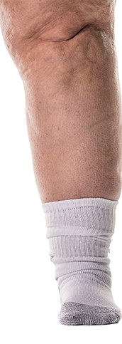 Obese leg wearing a poor fitting white sock
